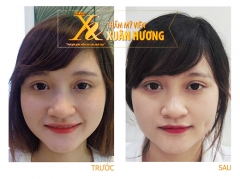 Hình ảnh trước và sau