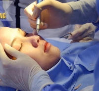Nâng mũi hàn quốc